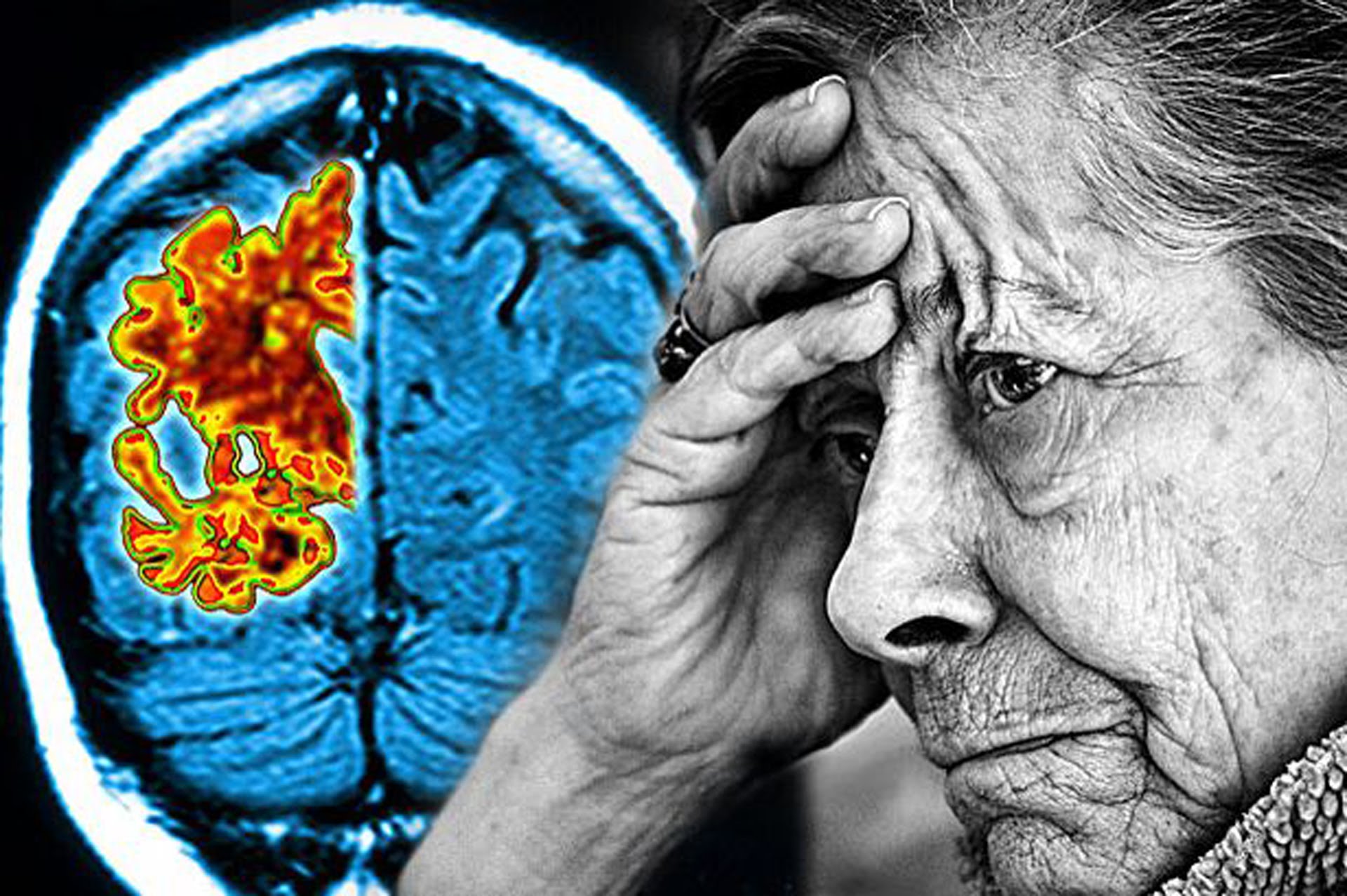 Θεραπεύεται το Alzheimer με υγιεινή διατροφή;