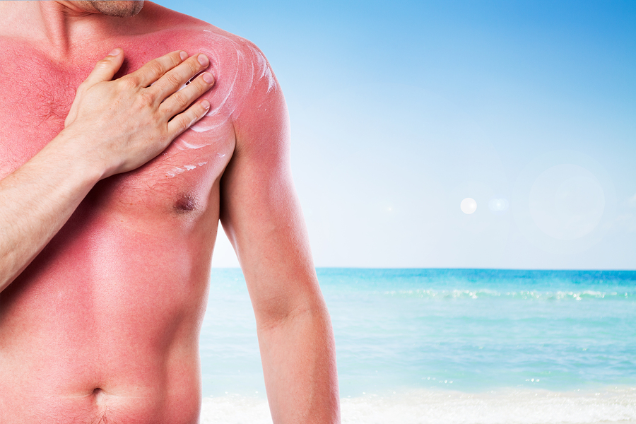 Ηλιακό έγκαυμα: Τα σωστά βήματα για να αντιμετωπίσετε το κάψιμο μετά την παραλία