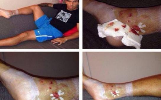 Shocking images from Tevez injury